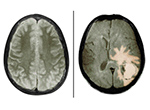 Image of Brain Tumor
