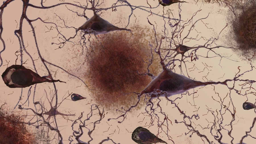 A rendering of amyloid protein plaques accumulating between neurons in the brain