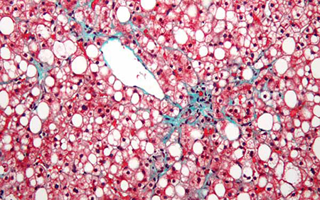 Image: A micrograph of an inflamed fatty liver