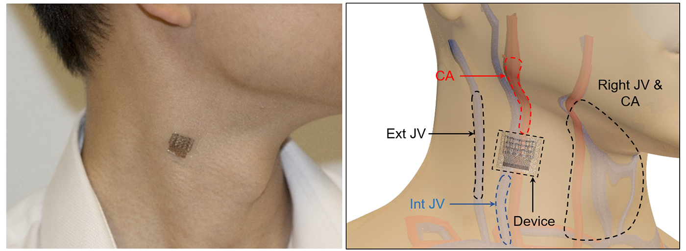 wearable ultrasound patch worn on the neck